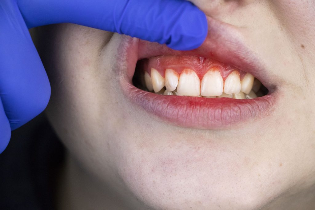 Understanding the Warning Signs and Food for your Gums and Teeth 