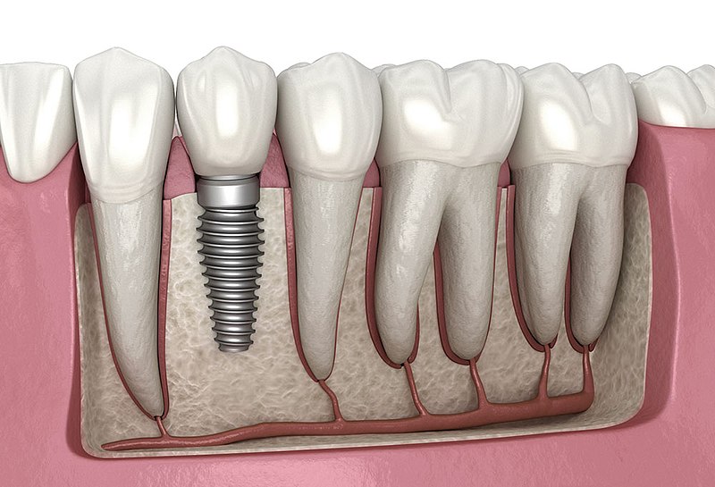 Restoring Your Oral Health and Smile with Precision Through Dental Implants